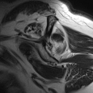 MRI Fatty Infiltration Supraspinatous Infraspinatous